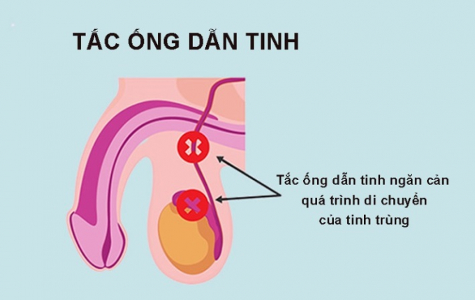 Không có tinh trùng